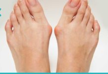 პოდაგრას მკურნალობა სახლის პირობებში