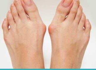 პოდაგრას მკურნალობა სახლის პირობებში