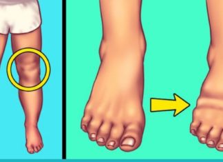 რა შეიძლება გამოიწვიოს მარილის ჭარბმა მოხმარებამ? ეს უნდა იცოდეთ