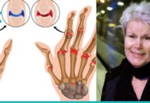 განიკურნეთ რევმატიზმისგან ამ მარტივი მეთოდის დახმარებით