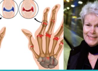 განიკურნეთ რევმატიზმისგან ამ მარტივი მეთოდის დახმარებით