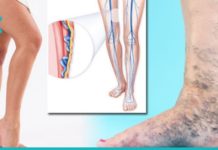 რატომ გვაწუხებს ვენები? ეს უნდა იცოდეთ