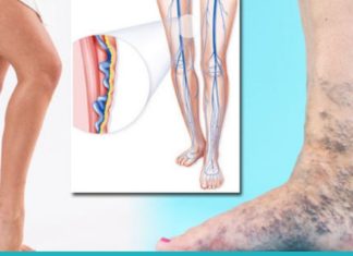 რატომ გვაწუხებს ვენები? ეს უნდა იცოდეთ