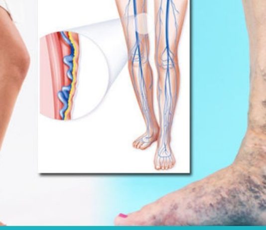 რატომ გვაწუხებს ვენები? ეს უნდა იცოდეთ