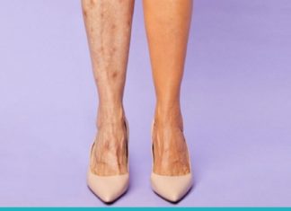 ვარიკოზული ვენების მკურნალობა ბუნებრივი მეთოდებით