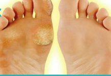 მაზოლების მოშორების 15 ეფექტური საშუალება