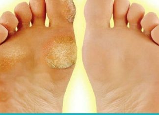 მაზოლების მოშორების 15 ეფექტური საშუალება