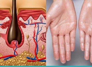 როგორ მოვიშოროთ ოფლიანობა? გაეცანით სასარგებლო რჩევებს