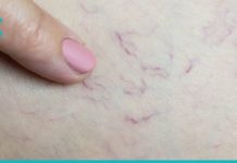 ასე მოვიშორე სისხლძარღვოვანი “ვარსკვლავები” ფეხებიდან წამლებისა და ოპერაციის გარეშე. სცადეთ თქვენც