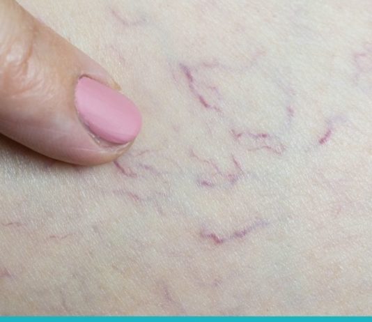 ასე მოვიშორე სისხლძარღვოვანი “ვარსკვლავები” ფეხებიდან წამლებისა და ოპერაციის გარეშე. სცადეთ თქვენც