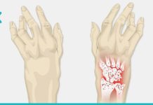 კარტოფილი და კეფირი- საუკეთესო საშუალება ართრიტის წინააღმდეგ!