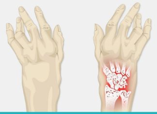კარტოფილი და კეფირი- საუკეთესო საშუალება ართრიტის წინააღმდეგ!