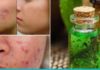 ეს ეთერზეთი ებრძვის აკნეს, ეგზემას და ფსორიაზს!