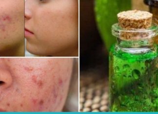 ეს ეთერზეთი ებრძვის აკნეს, ეგზემას და ფსორიაზს!