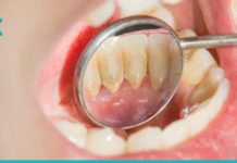 კბილებიდან ქვების მოცილების ეფექტური ხერხები