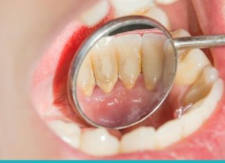 კბილებიდან ქვების მოცილების ეფექტური ხერხები