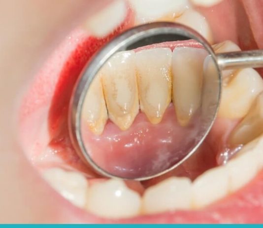 კბილებიდან ქვების მოცილების ეფექტური ხერხები