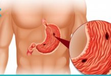 კუჭის წყლულის მკურნალობა სახლის პირობებში