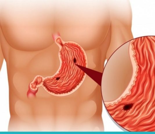 კუჭის წყლულის მკურნალობა სახლის პირობებში