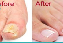 როგორ ვუმკურნალოთ ფეხის ფრჩხილის სოკოს? 3 ეფექტური საშუალება