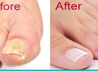 როგორ ვუმკურნალოთ ფეხის ფრჩხილის სოკოს? 3 ეფექტური საშუალება