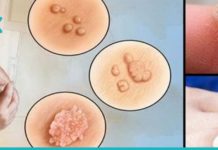 როგორ მოვიშოროთ მეჭეჭები ხელებიდან სახლის პირობებში