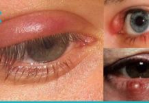 როგორ ვუმკურნალოთ კონიუნქტივიტს? 3 ხალხური რეცეპტი