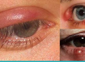 როგორ ვუმკურნალოთ კონიუნქტივიტს? 3 ხალხური რეცეპტი