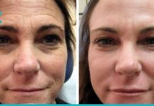 ეს ნიღაბი ეფექტურად, უმოკლეს დროში აქრობს ნაოჭებს.