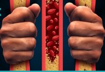 როგორ მოვიშოროთ ქოლესტერინი სახლის პირობებში?