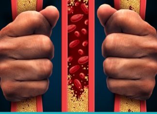 როგორ მოვიშოროთ ქოლესტერინი სახლის პირობებში?