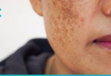 ნიღაბი, რომელიც დაგეხმარებათ მოიშოროთ სახიდან მუქი ლაქები