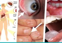 როგორ მოქმედებს რკინის დეფიციტი ჩვენს ჯანმრთელობაზე და როგორ შეიძლება ამ პრობლემის მოგვარება?