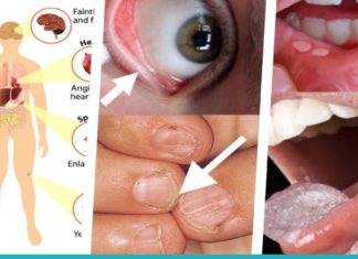 როგორ მოქმედებს რკინის დეფიციტი ჩვენს ჯანმრთელობაზე და როგორ შეიძლება ამ პრობლემის მოგვარება?