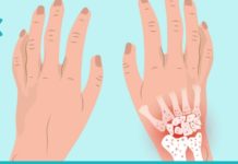 8 ბუნებრივი მეთოდი მაჯის ტკივილის შესამსუბუქებლად