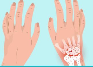 8 ბუნებრივი მეთოდი მაჯის ტკივილის შესამსუბუქებლად