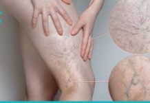 “ვარიკოზული ვენები დიდი ხნის განმავლობაში მტანჯავდა, სანამ ეს სამკურნალო მეთოდი არ აღმოვაჩინე.”