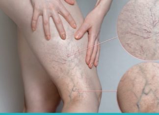 “ვარიკოზული ვენები დიდი ხნის განმავლობაში მტანჯავდა, სანამ ეს სამკურნალო მეთოდი არ აღმოვაჩინე.”