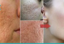 თქვენ სულ რაღაც 1 ინგრედიენტი გჭირდებათ იმისათვის, რომ მოიშოროთ გაფართოებული ფორები სახეზე