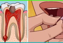 თქვენ ნამდვილად შეგიძლიათ თავი დააღწიოთ კბილის აუტანელ ტკივილს სახლის პირობებში