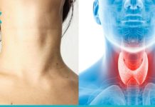 Ჰიპოთირეოზი – როგორ ვებრძოლოთ?