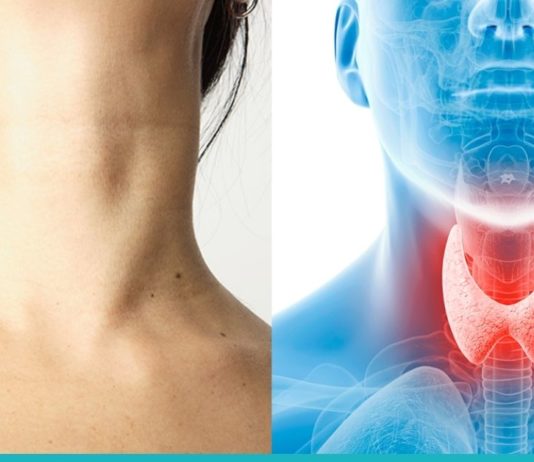 Ჰიპოთირეოზი – როგორ ვებრძოლოთ?