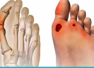 5 საოჯახო სამკურნალო საშუალება ბურსიტის მოსაშორებლად