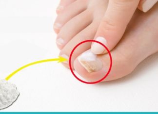 ფრჩხილის სოკოს მოშორების უმარტივესი მეთოდი. შედეგი გარანტირებულია!