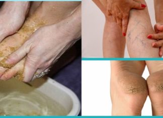 შეიზილეთ ეს ნარევი ფეხებზე და დაემშვიდობეთ ვარიკოზულ ვენებს, მაზოლებსა და დამსკდარ ქუსლებს სულ რაღაც 10 დღეში