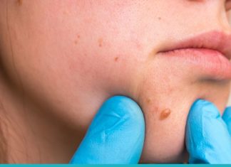 მოიშორეთ პაპილომები კანიდან ამ საშინაო მეთოდების დახმარებით