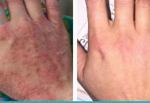 ხელის საოცარი ნიღაბი, რომელიც თქვენს ხელის კანს უფრო რბილს და ელასტიურს გახდის