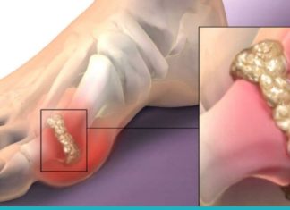 შეამცირეთ შარდმჟავას მაღალი შემცველობა ბუნებრივი გზებით