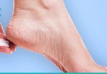 სახლში დამზადებული სკრაბი, ნიღაბი და მალამო დამსკდარი ქუსლებისთვის