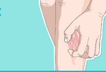 ბუნებრივი საშუალებები ფსორიაზის საწინააღმდეგოდ. სცადეთ ეს რეცეპტები